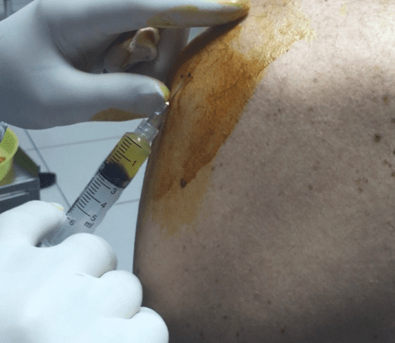 shoulder treatment with stem cells
